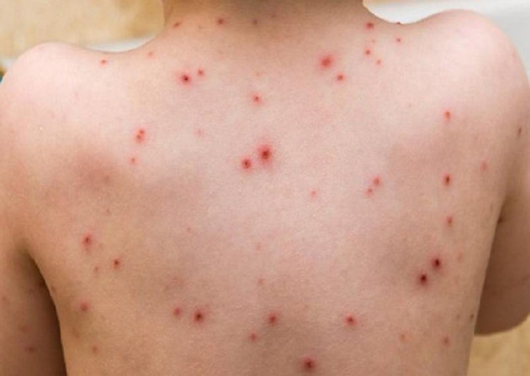 Bệnh đậu mùa mang khả năng lây lan cao bởi virus