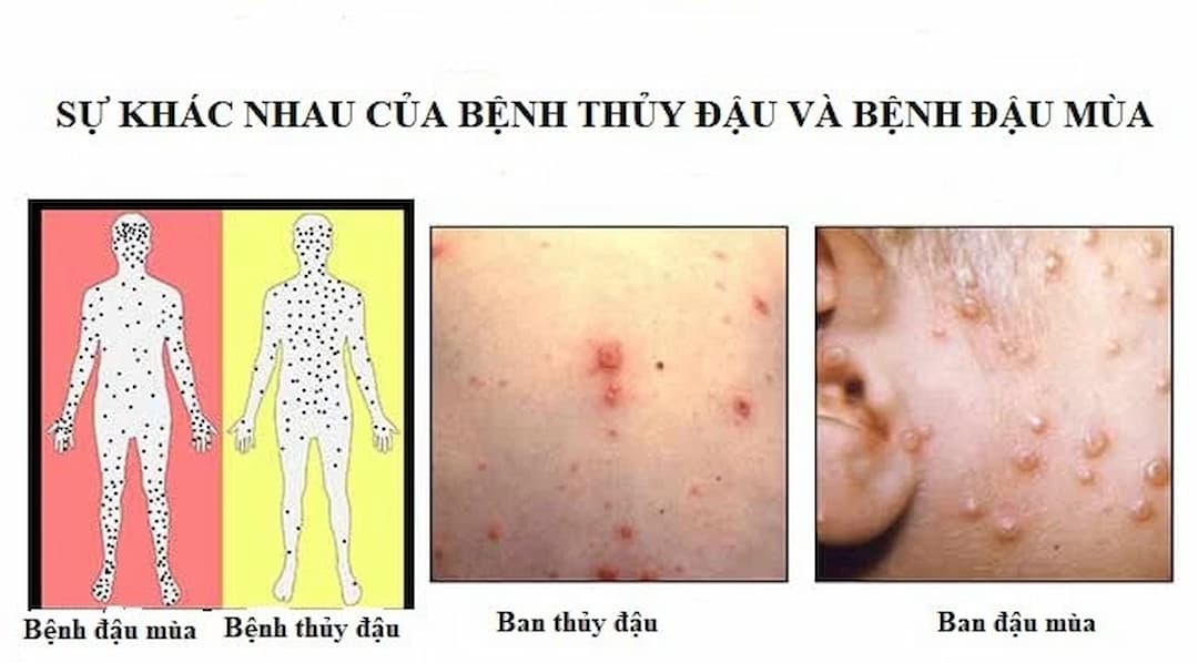 2 loại bệnh do 2 loại virus khác nhau gây ra.