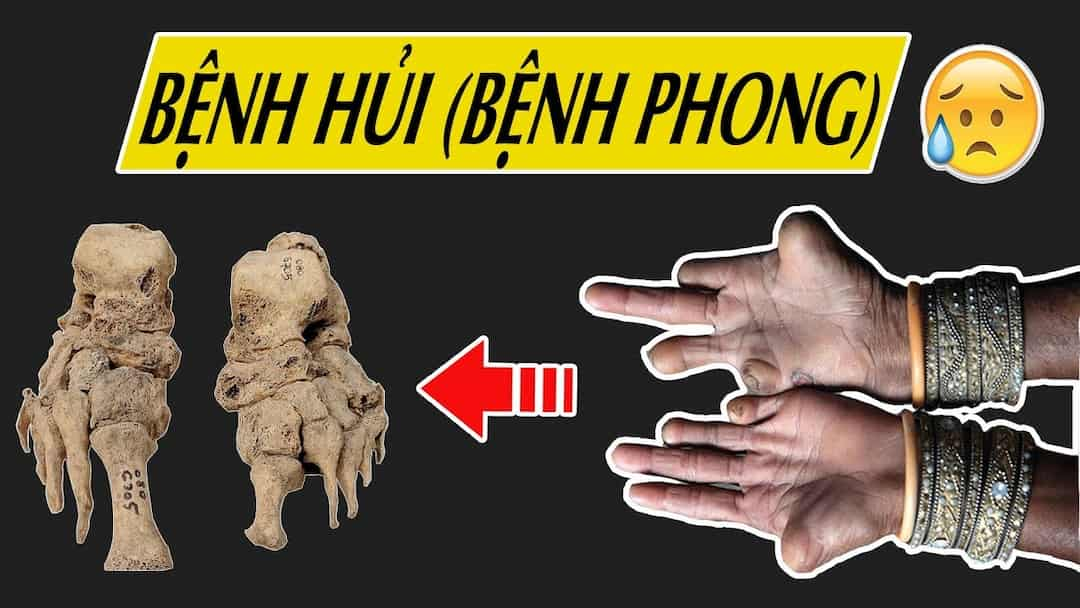 Các thông tin về bệnh phong cùi