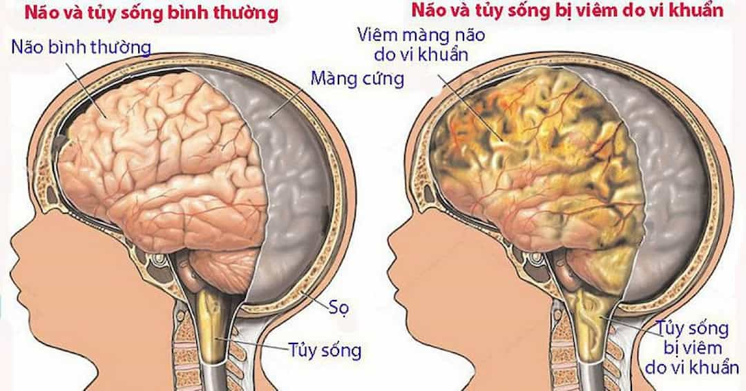 Dấu hiệu lao màng não ở người bệnh còn phụ thuộc vào thời gian mắc bệnh.