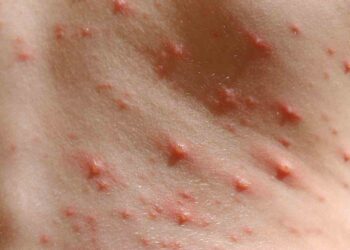 Đậu mùa gặp phải do virus variola gây ra thuộc loài Orthopoxvirus