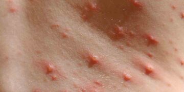 Đậu mùa gặp phải do virus variola gây ra thuộc loài Orthopoxvirus