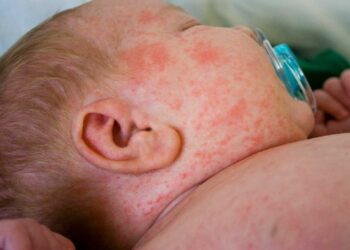 Bệnh sởi rất phổ biến trên thế giới với tình trạng lây lan nhanh
