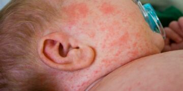 Bệnh sởi rất phổ biến trên thế giới với tình trạng lây lan nhanh