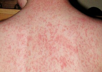 Sốt phát ban là tình trạng da bị tổn thương do nốt mẩn đỏ