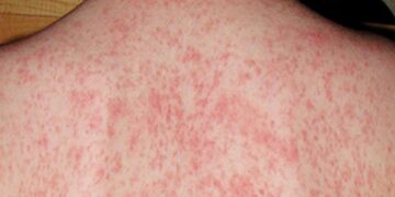 Sốt phát ban là tình trạng da bị tổn thương do nốt mẩn đỏ