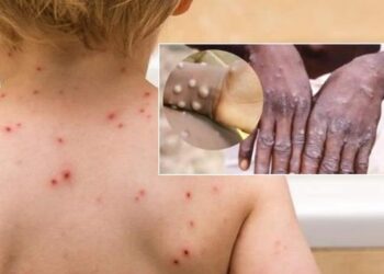 Bệnh đậu mùa lây qua đường nào