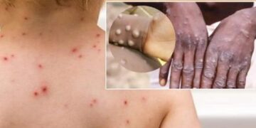 Bệnh đậu mùa lây qua đường nào