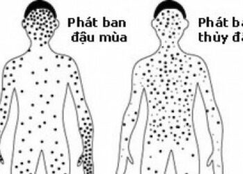 Điểm giống và khác nhau của bệnh đậu mùa và thủy đậu
