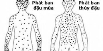 Điểm giống và khác nhau của bệnh đậu mùa và thủy đậu