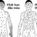 Điểm giống và khác nhau của bệnh đậu mùa và thủy đậu
