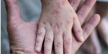 Các giai đoạn của bệnh đậu mùa