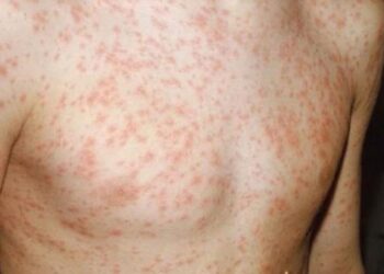 Cách trị sốt phát ban ở người lớn