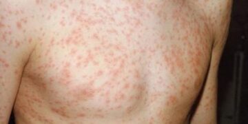 Cách trị sốt phát ban ở người lớn