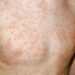 Cách trị sốt phát ban ở người lớn