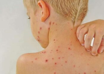 Sốt phát ban có ngứa không?