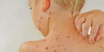 Sốt phát ban có ngứa không?