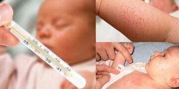 Trẻ em sốt phát ban kiêng gì
