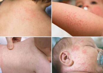 Trẻ sốt phát ban kiêng gì