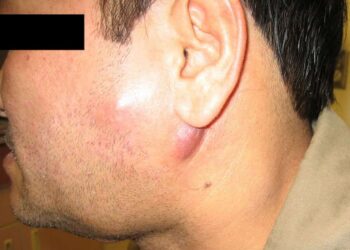 Bệnh lao hạch có lây không