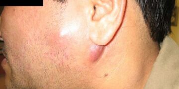 Bệnh lao hạch có lây không