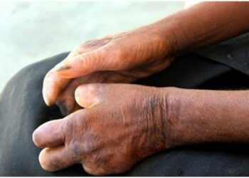 Bệnh phong cùi có lây không? Các thông tin cần biết!