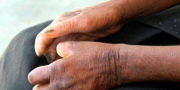 Bệnh phong cùi có lây không? Các thông tin cần biết!