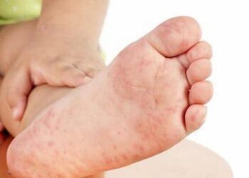 Bị bệnh sởi phải kiêng nước