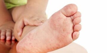 Bị bệnh sởi phải kiêng nước