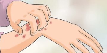 Các giai đoạn HIV và biểu hiện của từng giai đoạn cần biết