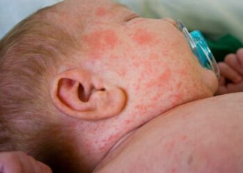 Cách phòng bệnh sởi