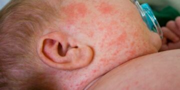 Cách phòng bệnh sởi