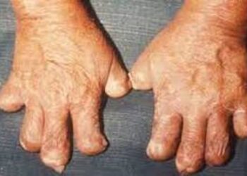 Dấu hiệu nhận biết bệnh phong, nguyên nhân gây bệnh