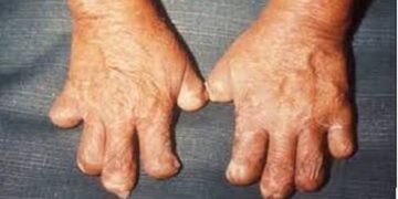 Dấu hiệu nhận biết bệnh phong, nguyên nhân gây bệnh