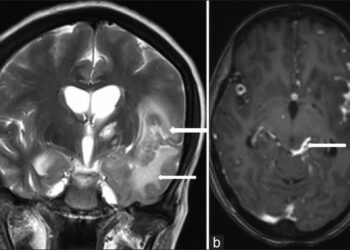 Bệnh lao màng não