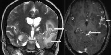 Bệnh lao màng não