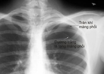 Bệnh lao màng phổi có lây không