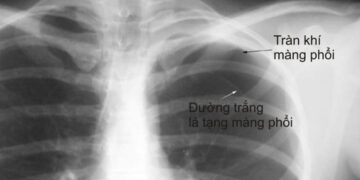 Bệnh lao màng phổi có lây không