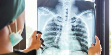 Phác đồ điều trị lao phổi